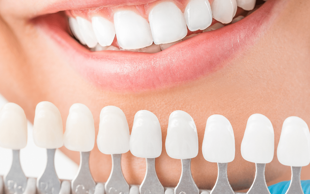 Comfortable & Convenient Teeth Whitening